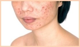 what is adult acne?