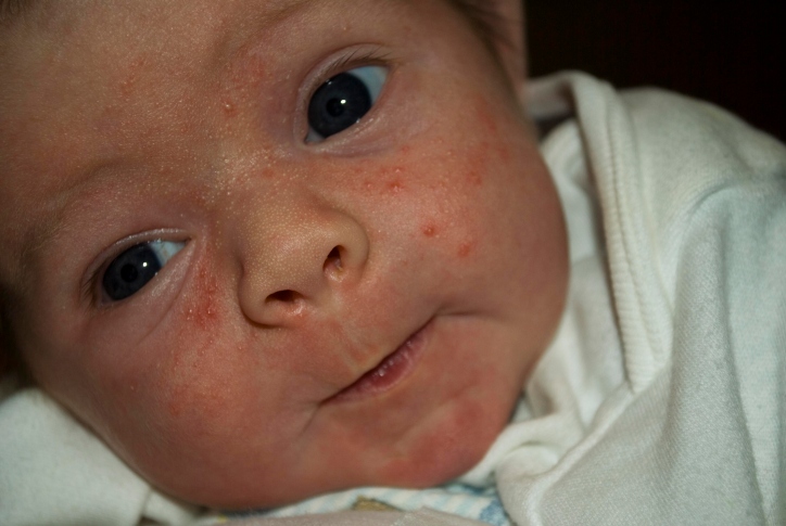 How do you treat baby acne?
