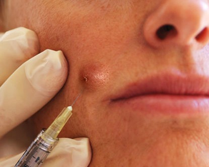 Acne steroid injection side effects