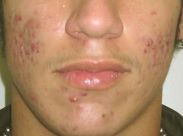 cystic acne