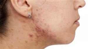 adult acne