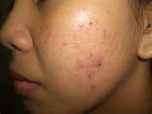 hormonal acne